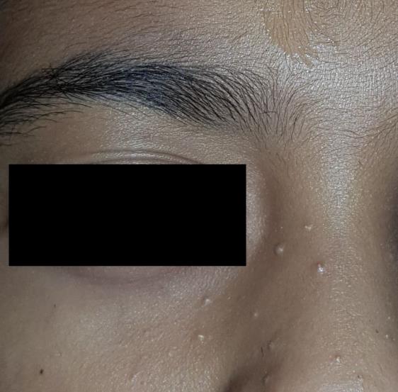 Figure 4: Complete resolution of lesions after 6 weeks.