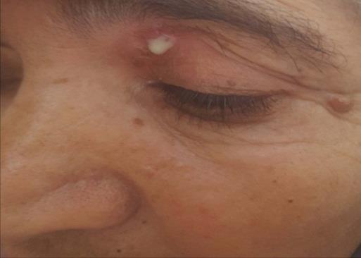 Figure 1: Left upper eyelid fistula with pus discharged beneath the brow ridge.