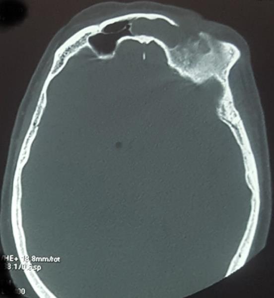 Figure 2: Sinusitis and osteitis of the frontal sinus with dehiscence of the anterior sinus wall. (A) axial cerebral CT ;(B) coronal paranasal sinus CT.