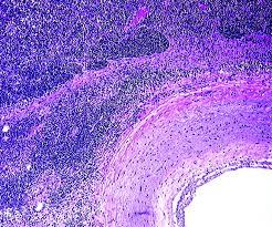 Figure 10: Extra nodal NK/T cell lymphoma: intense aggregates of enlarged, anomalous lymphoid cells [23].