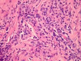Figure 3: Extra nodal NK/T cell lymphoma: Angio- invasive configuration of aberrant lymphoid cells [17].