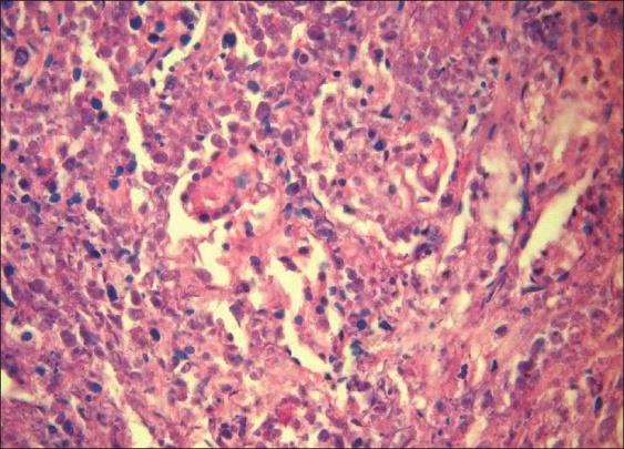 Figure 7: Extra nodal NK/T cell lymphoma: enlarged, aberrant lymphoid cells with mucosal ulceration [20].