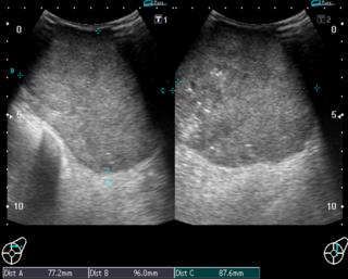 Figure 2: Ultrasound shows an echogenic, well defined mass.