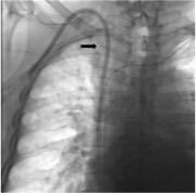 Figure 3: Venous angiography: Post-procedural chest x-ray that evidences a high flow catheter that is adequately placed.