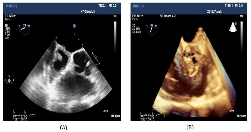 Figure 3: A) 2D TEE showing aortic root abscess. B) 3D TEE of the aortic valve with accurate localization of the abscess from 6 o’clock to 11 o’clock.