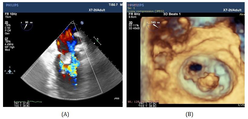 Figure 4: A) 2D TEE of the mitral valve showing large vegetation with suspected peroration at the anterior mitral leaflet. B) 3D TEE of the mitral valve that confirm the perforation at A1 scallop.
