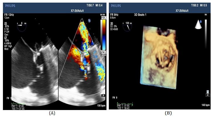 Figure 8: A) 3D TEE of the prosthetic aorta showing prosthetic valve dehiscence extending from 6 o’clock to 3 o’clock. B) 2D TEE showing severe paravalvular regurgitation of the prosthetic aortic valve.