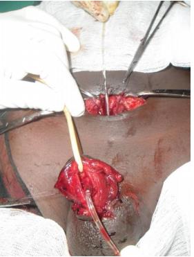 Figure 2: operative ventral view of penis with the site of penetrating penile wound and rupture of corpus Cavernosum.