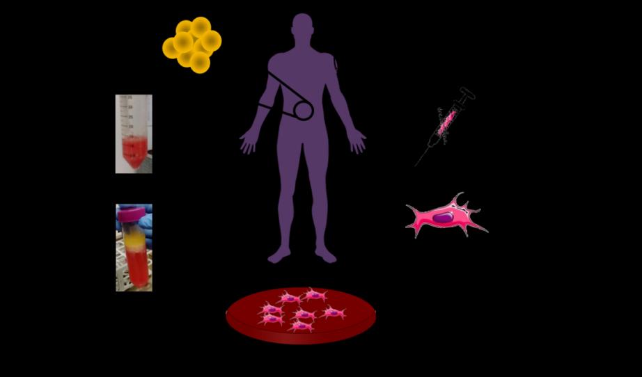Figure 1: Schematic representation of the procedure for MSCs treatment from adipose tissue extraction to cells infusion.