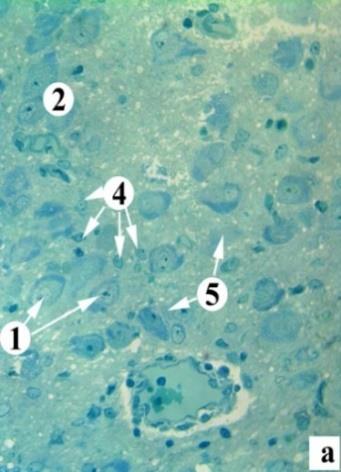 Figure 4: The bipolar cell’s (а) and ganglion (б) neuron dystrophy and destructive changes for animal of II group at the 30th day after experiment Electronmicroscopy. Magn: а) x4800, б) x6400 Notes: 1 – neuron’snuclei, 2 – mitochondria, 3 – vacuole, 4 – granular endoplasmicnet, 5 – colicvativenecrosisofneuron, 6 – enlightenment of the axoplasm in NFL.
