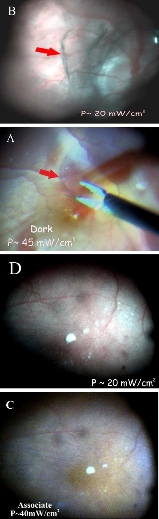 Figure 3: The frames of video recording of the operating field on the fundus: A) using the Xenon Bright Star, B and D) using a spectrally selective emitter (λ=520, 577 and 650 nm), C) using LED emitter.