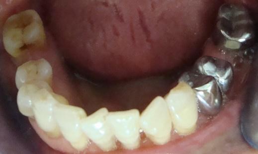 Figure 2: Mandibular Arch. Examination of the maxillary and mandibular incisors showed slight tooth mobility. Examination of the occlusion showed a prosthetic occlusal height reduced on the right side due to the tooth 47egression (Figure 3).
