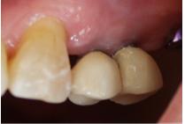 Figure 8: View of crowns sealed on the abutments.