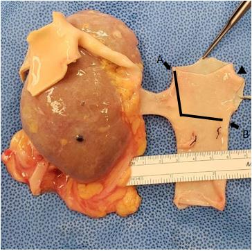 Figure 1: Standard deceased donor right kidney with full vena cava cuff. Reconstruction by cutting through the lines to join points A and B as shown in Figure 2. Notice the recommended 3-4 mm IVC cuff from the LRV to facilitate reconstruction (arrow head).