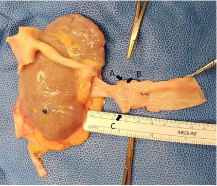 Figure 2: Anatomical extension using IVC cuff, point C can have so called “dog ears” that might need to be trimmed/repaired.
