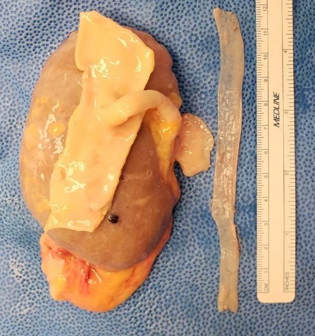 Figure 5: Use of autologous vein, in this case the gonadal, can be used to create conduits for further extension in the occasional RRV with a damaged or absent IVC.
