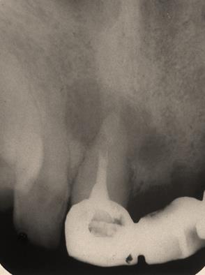 Figure 4: Radiographic of root canal.