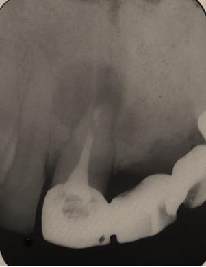Figure 5: Radiograph of tooth immediately post- surgery tooth taken 6 months at periapice region.