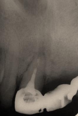 Figure 6: Radiograph of post-surgery revealed absence of radiolucent area.