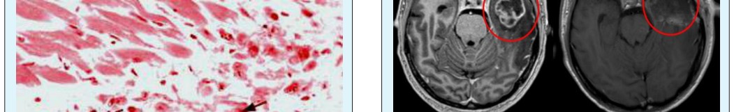Figure 11: Bowel Cancer.