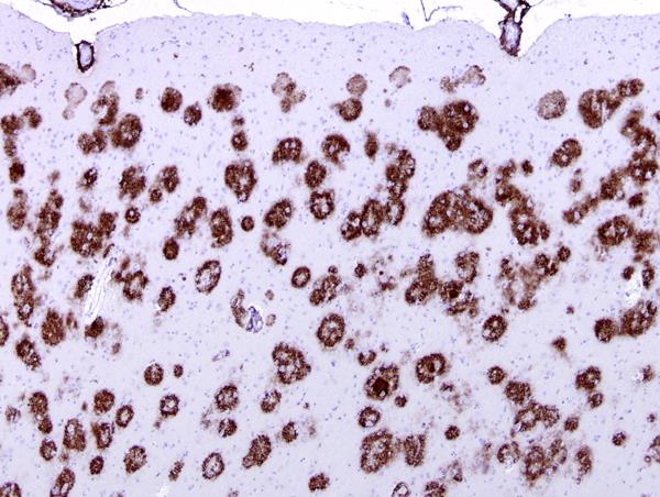 Figure 5: Since from the characteristic pattern of some hair loss due to hair follicle death to the migraine presentation, Alzheimer disease (Figure 7), Parkinson PD, cerebral ictus or to the nerve death in diseases like SMA spinal muscular atrophy, death of retina in ophthalmological diseases to blindness a topographic relation can be observed (inside all the tissue involved) (Figures 8-10). • Thromboembolic disease • Septic shock • Epilepsy • Cathecolamines hyperproduction • Peptic ulcera retaled to high stressing condition • Chron disease • And many other conditions can be interesting to be observed under a local micro-environmental process.