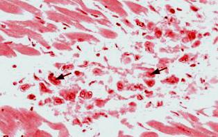 Figure 8: Cardiac amyloidosis.