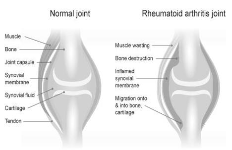 Figure 1: Normal Joint vs. RA joint.
