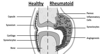 Figure 2: On the left side a healthy joint includes a small amount of synovium and a lining layer of Synoviocytes. On the right sight, in the Rheumatoid joint, immune cells quickly change their place to sublining and by release of chemokines or cytokines they attract more immune cells into the area, causing an inflammatory cycle [14]. Citrullination: Citrullination is a term referring to the modification of the arginine amino acid into citrulline after transcription. In recent years, evidence has suggested a link between RA and anticitrullinated protein antibodies or ACPAs, which currently measure as anticyclic citrullinated peptide autoantibodies. Recently, Anticitrullinated protein antibodies (ACPAs) isolated from RA sera, through binding to 78 kDa glucose- regulated protein or GRP78, a citrullinated surface expressed protein, were shown to increase the activity of TNFa and NF-kB production in macrophages or monocytes [1].