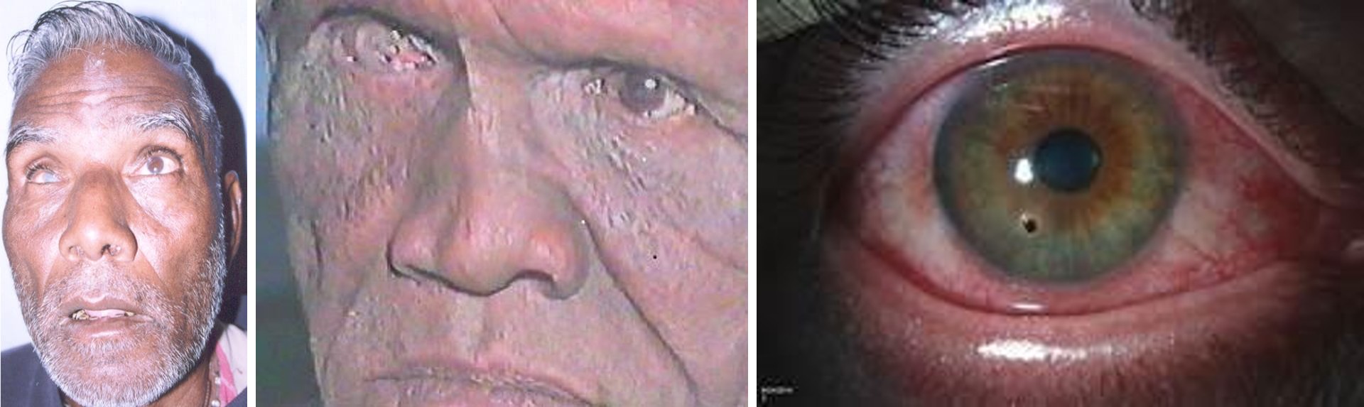 Figure 1: A: Corneal opacity, B: Trauma to eye, C: Corneal foreign body.