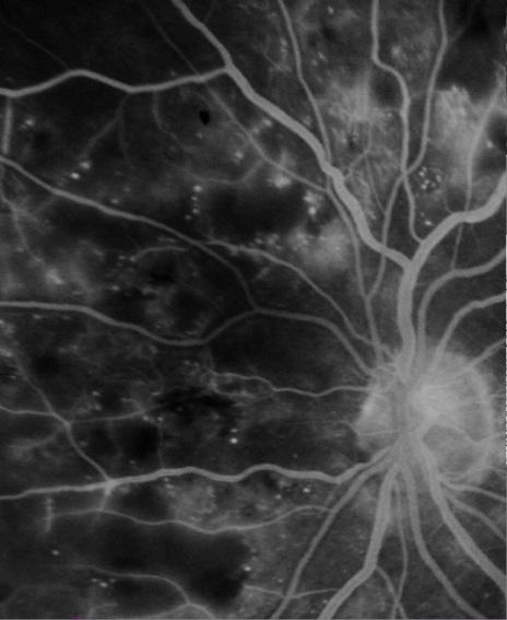 Figure 10: Intraretinal microvascular abnormalities (IRMA).