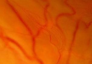 Figure 12: Retinal Neovascularization with