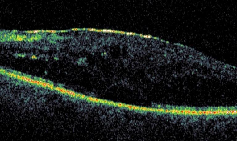 Figure 5: Shows macular thickening due to vitreomacular thickening with focal disturbance of inner retinal layers.
