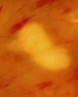 Figure 8: Cotton wool spots.