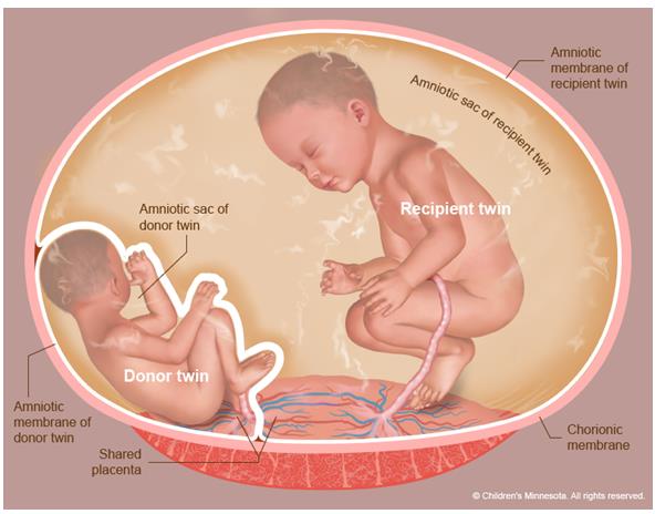 Figure 2: Schematic view of TTT syndrome in human embryo.