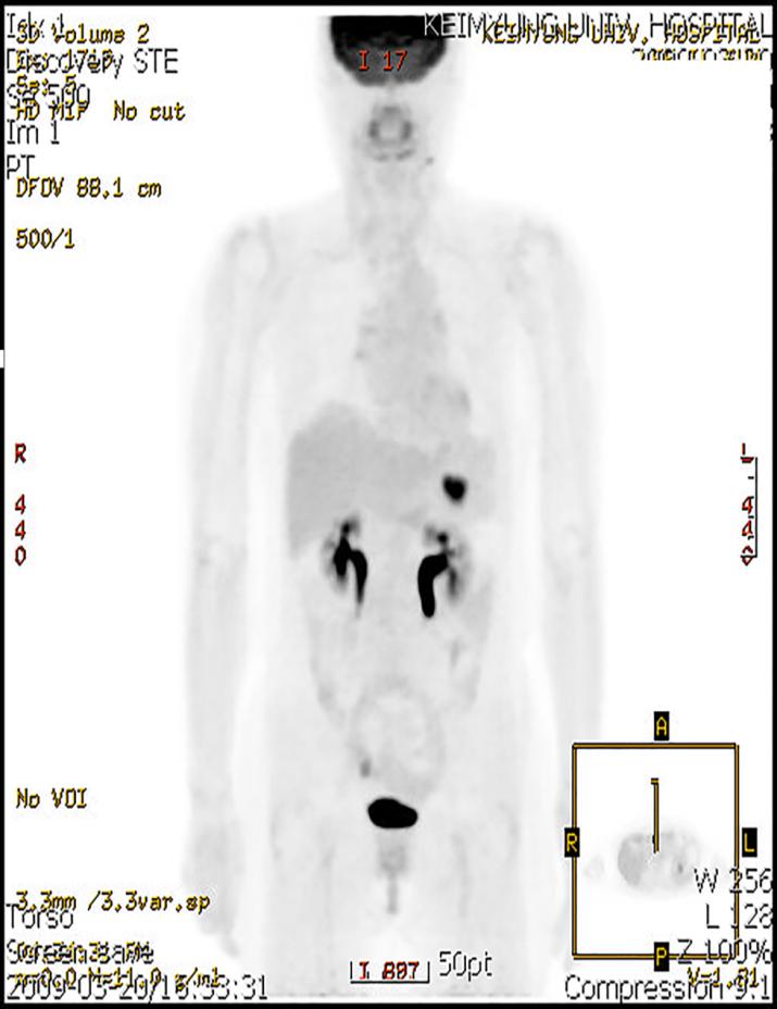 Figure 1: PET scan revealed a newly formed, large, well-defined, round, intense hypermetabolic lesion at the inverted splenichilum.