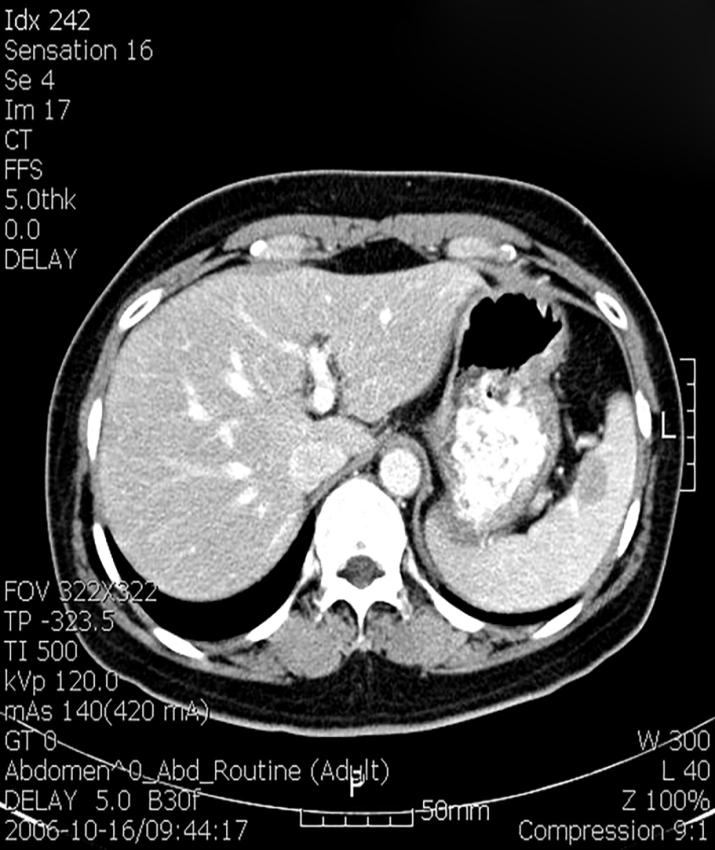 Figure 3: CT showed visible low-attenuating nodules in the spleen.