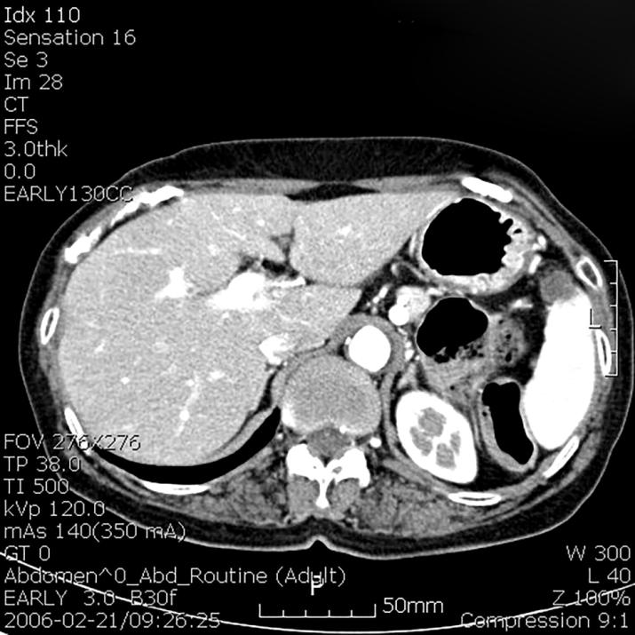 Figure 5: CT demonstrated an 11-mm solid nodule in the spleen.