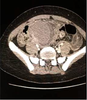 Figure 3: Abdominal transverse CT.