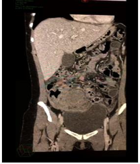 Figure 4: Abdominal coronal CT.
