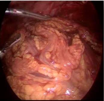 Figure 5: Pelvic mass with omentum plastron, laparoscopic view.