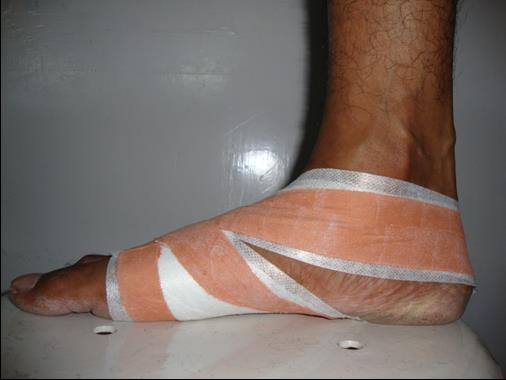 Figure 3: Antipronation Taping on a subject.