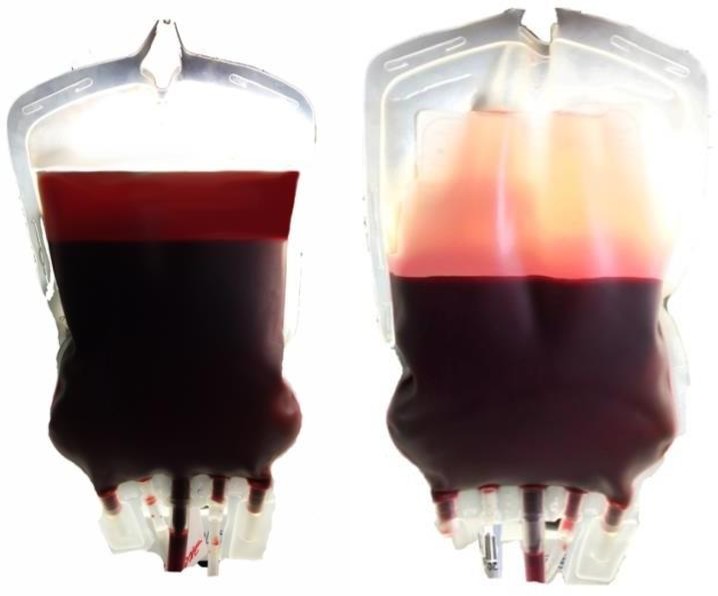 Figure 1: The hemolysis inhibition effect with using method of additive modernization of preservative solutions adapted to the manufacture process on the 35th day of the study.