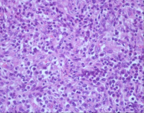 Figure 2: Biopsy of an inguinal lymph node.