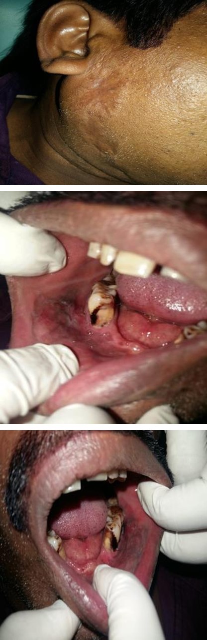 Figure 1: Scar seen on right side extending from preauricular region till submandibular region.