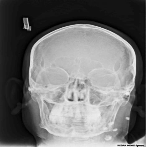 Figure 3: Panoramic radiographs showing unilateral radiopaque masses in posterior border of ramus, angle of mandible and inferior to antegonial notch.