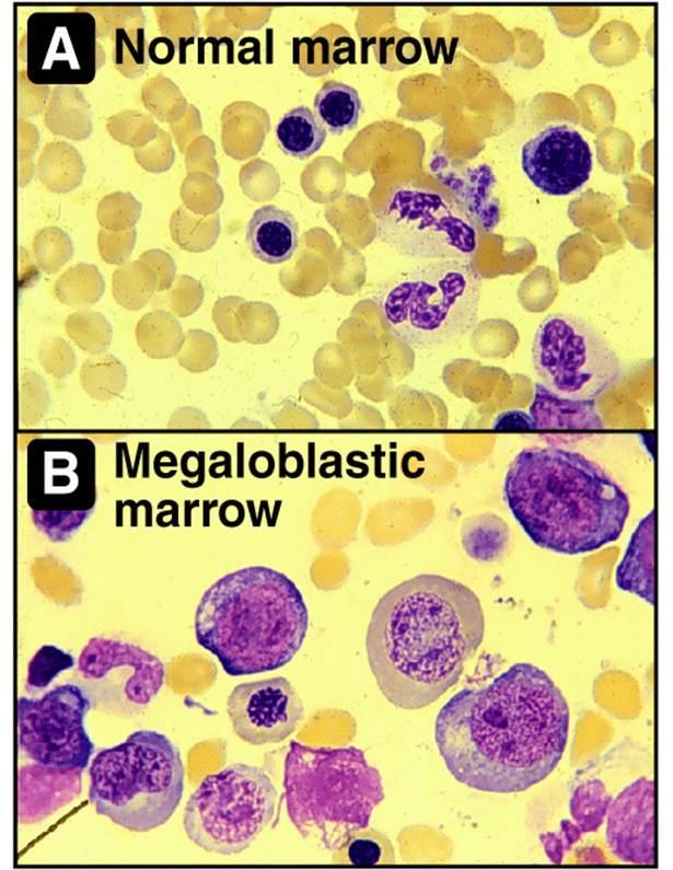 Figure 6: Microscopic Image of normal bone marrow (A) against megaloblastic bone marrow due to vitamin B9 deficiency (B).