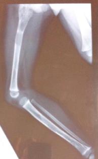 Figure 1: X-ray of the lower limb showing FD of the proximal femur and tibia.