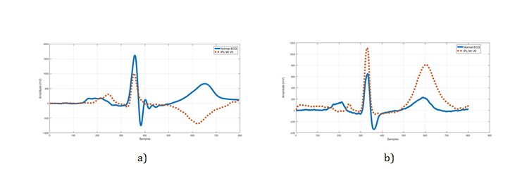 Figure 2: This illustration shows the morphological variation between two normal ECG pulses and two disease states: