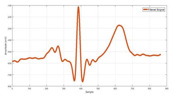Figure 3: ECG waveform artifact and noise removal: a) Signal corrupted with motion artifacts from cardiology clinic database; b) Filtered signal after IIR low-pass filter; c) Signal with base line attenuation; d) De-trend signal after using Notch filter.