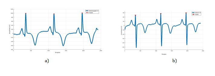 Figure 6: After that, the stemming filter for data reduction is applied. The remained data will contain segments of the pathological signal that indicate the differ part from the normal rhythm. Features extraction is an attempt to find strong morphological variation in diseases group that will monitor the diseases’ subtype. The stemming filter uses data reduction and the remaining data contain some segments from the signal that indicates the different part from the normal. Stemming filter is based on similarity function. Similarity function is used to compare all samples in pathological leads with the reference signal (the normal), all samples in the pathological group that share the same value with the normal will be removed. Remaining data contain morphological roots that have a property difference from normal leads (Figure 6).